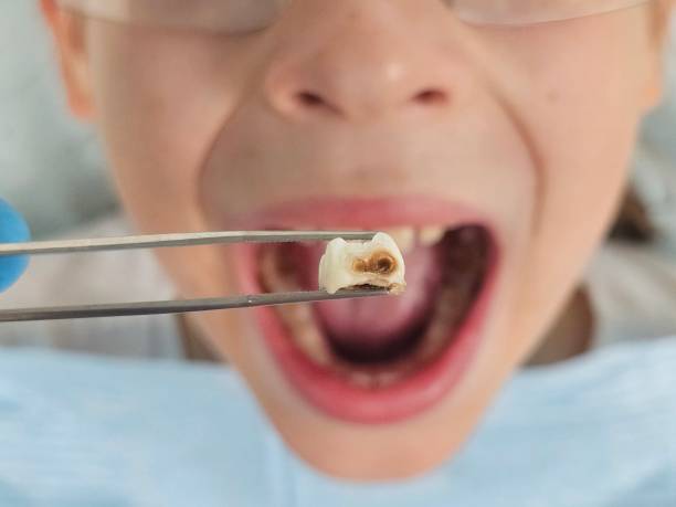 Best Emergency Treatment for Toothache in San Carlos, TX